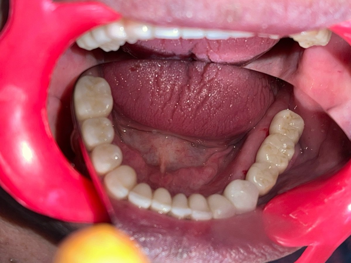 Colocación de implantes corticobasales: después del tratamiento