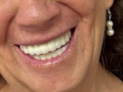 Sonrisa después del tratamiento de implantes